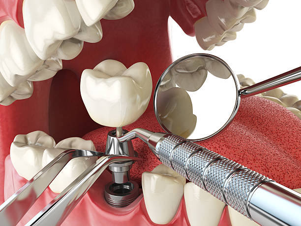Best Chipped Tooth Repair Near Me  in Whitwell, TN